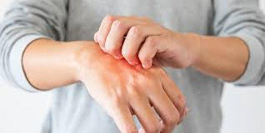 CBD Topicals for Eczema: Can They Help with Symptoms? - NanoCraft